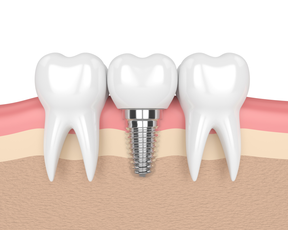 dental implant